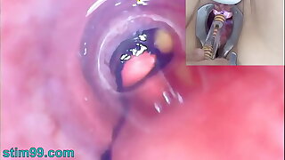 Mature Woman Peehole Endoscope Camera in Bladder with respect to Malarkey